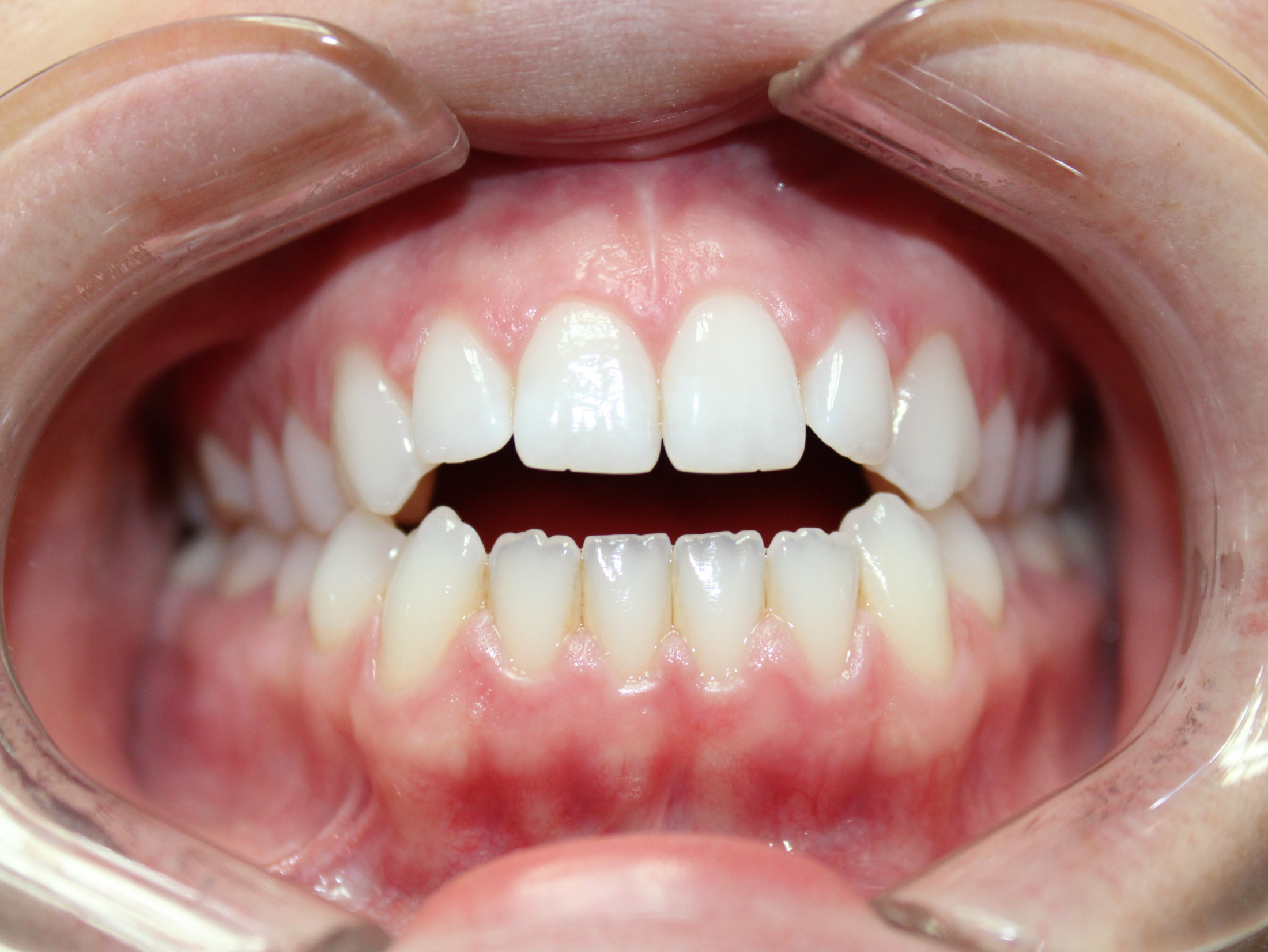 Before Invisalign
