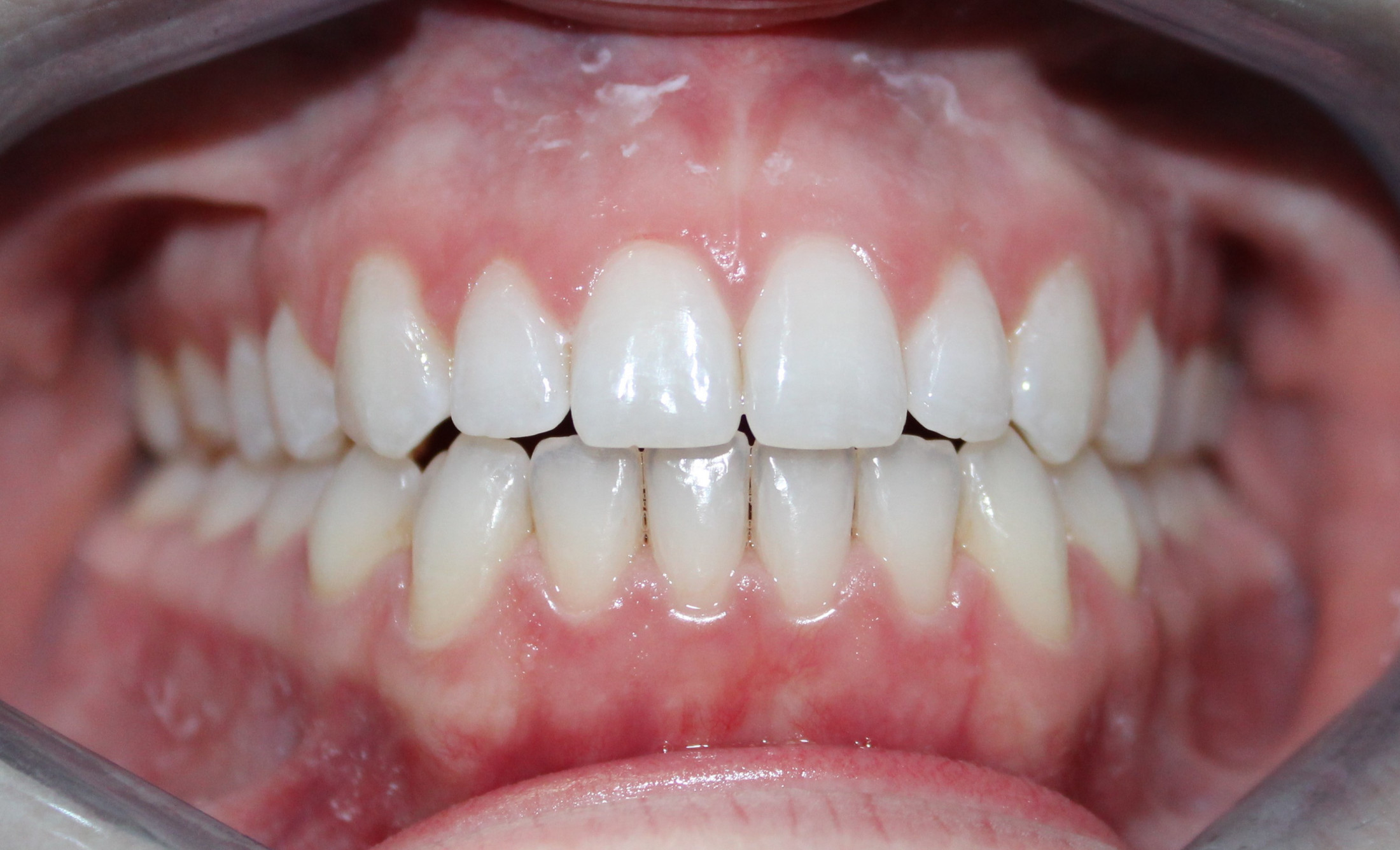 After Invisalign